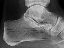 Radiographic measurements of the talus and calcaneus in the adult pes ...