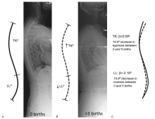 Schematic of parity-related differences in thoracic kyphosis and lumbar lordosis from regression analyses