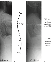 Schematic of parity-related differences in thoracic kyphosis and lumbar lordosis from regression analyses